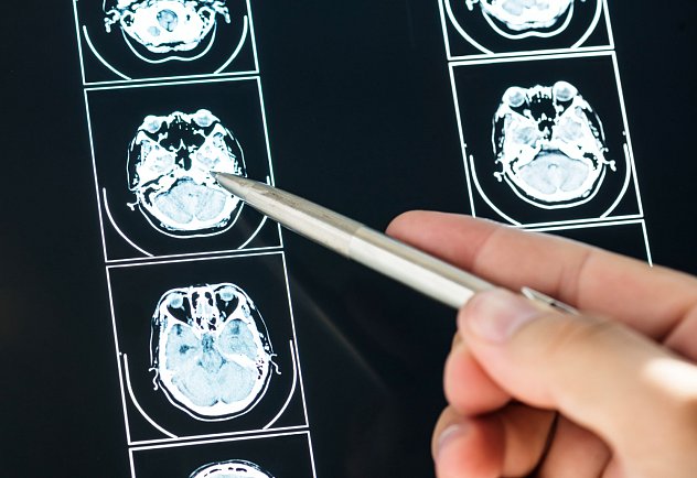 Štyri roviny psychoterapia po úraze mozgu
